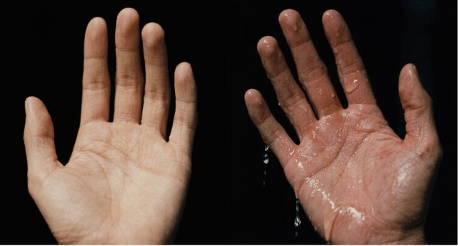 双手常年“湿漉漉”?别只当是“爱出汗”,可能是手汗症在困扰