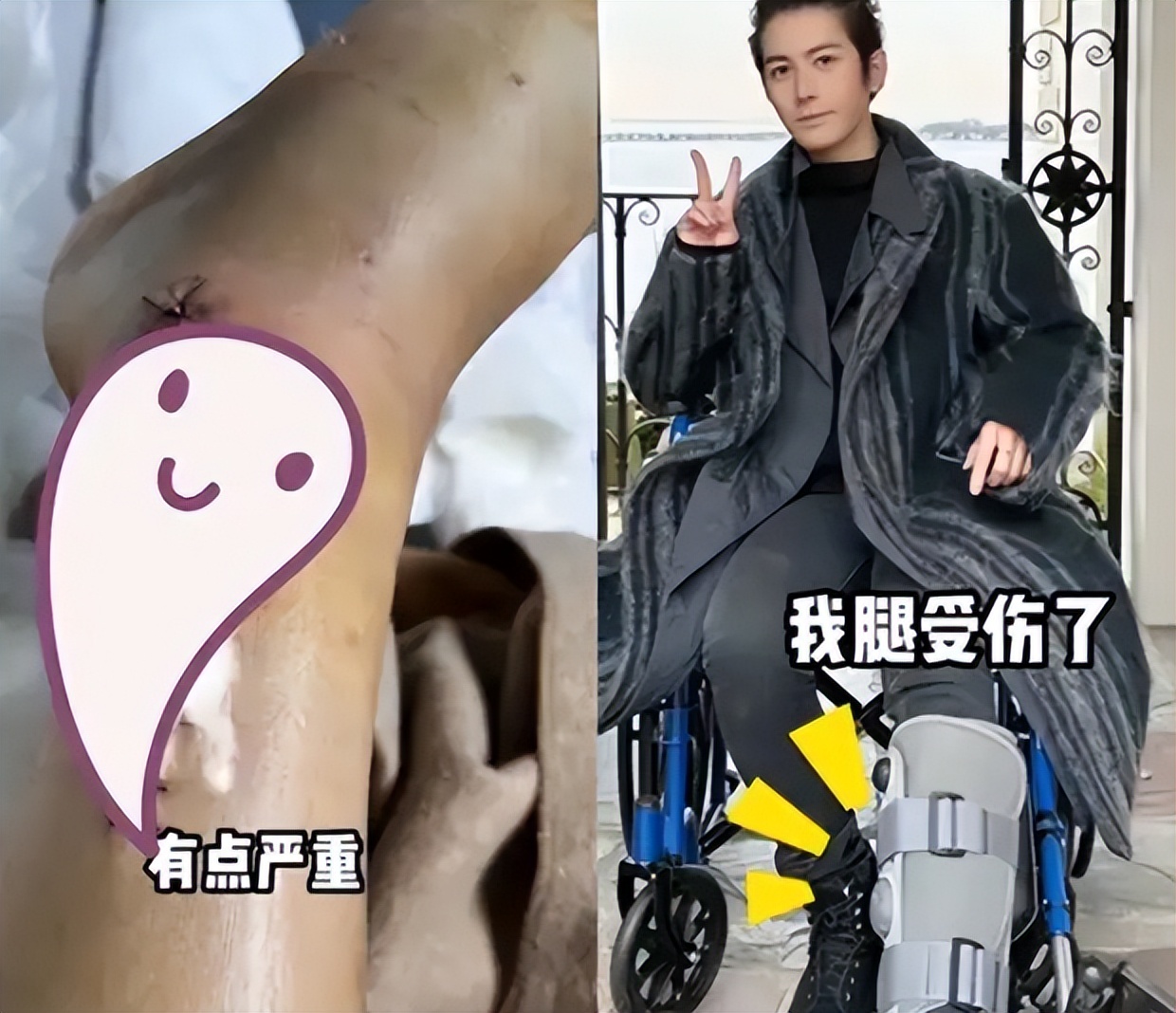 演员陈学冬：11部作品被下架，两年4次手术，今35岁生活无法自理__演员陈学冬：11部作品被下架，两年4次手术，今35岁生活无法自理