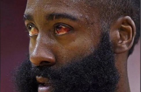 哈登90度骨折__哈登g1受伤